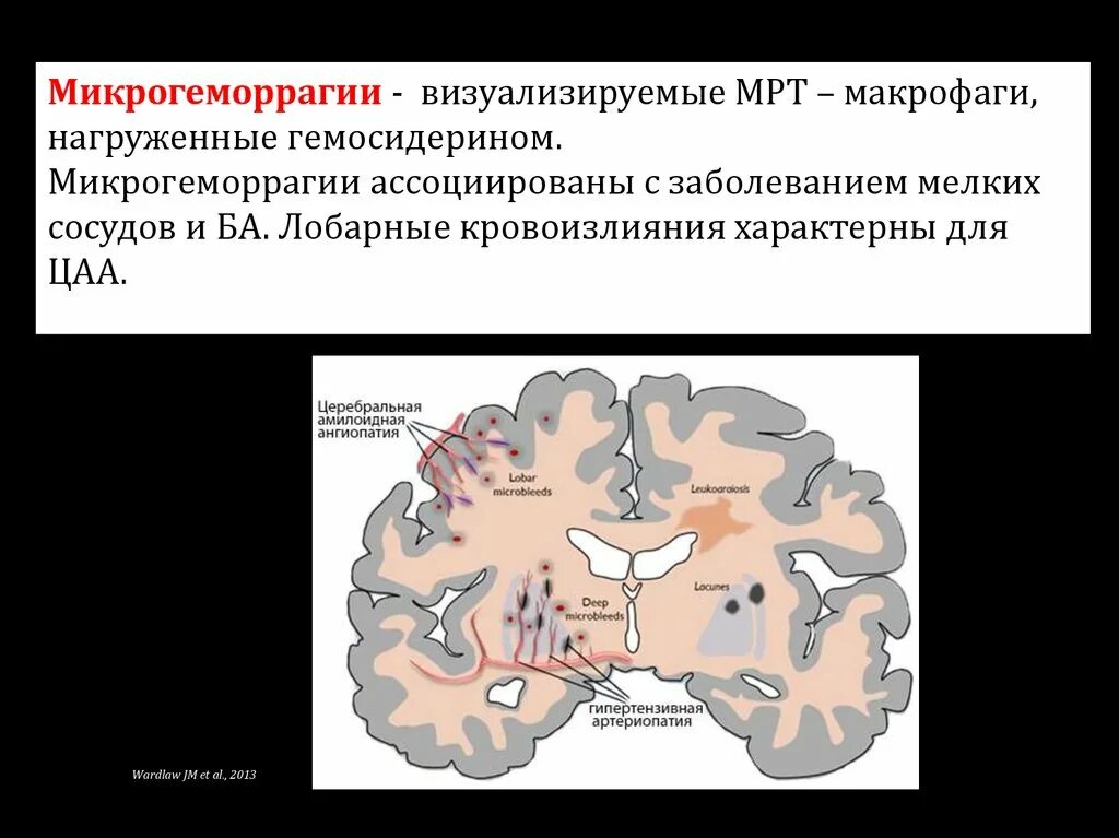 Макрофаги с гемосидерином. Макрофаги нагруженные гемосидерином. микрогеморрагии головного мозга.