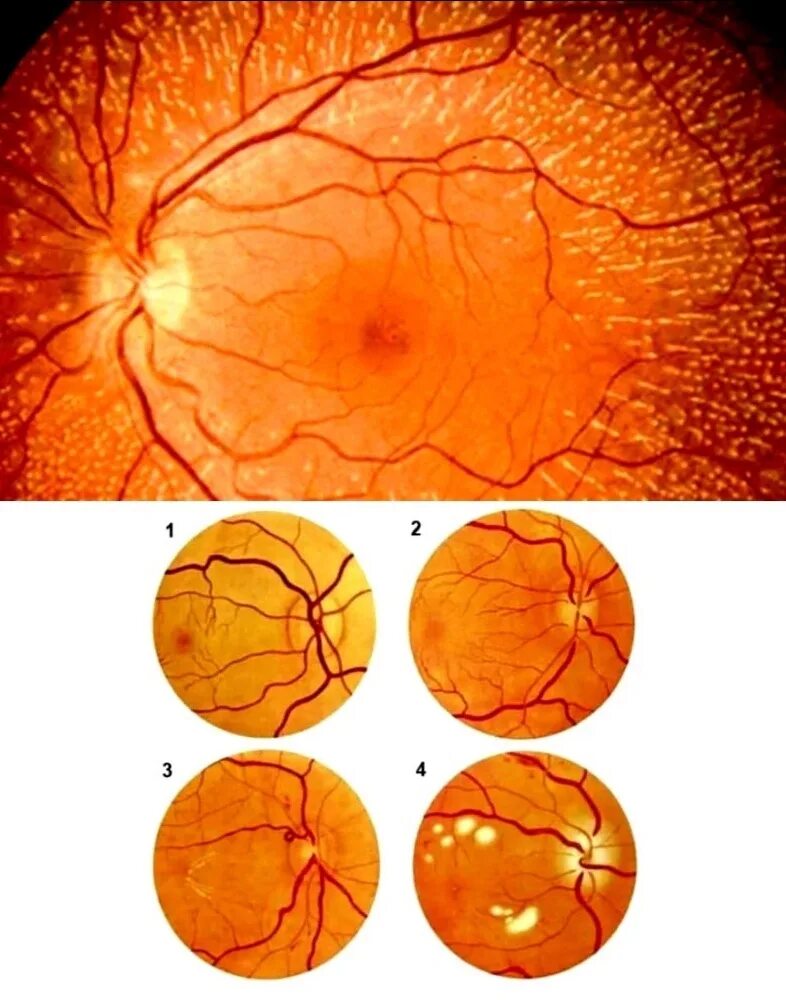 Диабетическая ангиопатия глаз. Лентикулостриарная ангиопатия. Диабетической гипертоническая ангиопатия. Ангиопатия сосудов сетчатки глаза. Ангиопатия сосудов сетчатки что это