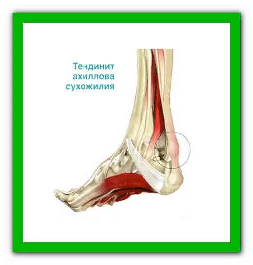 Тендинит ахиллова сухожилия. Ахиллово сухожилие воспаление. Тендинит ахиллова стопы.