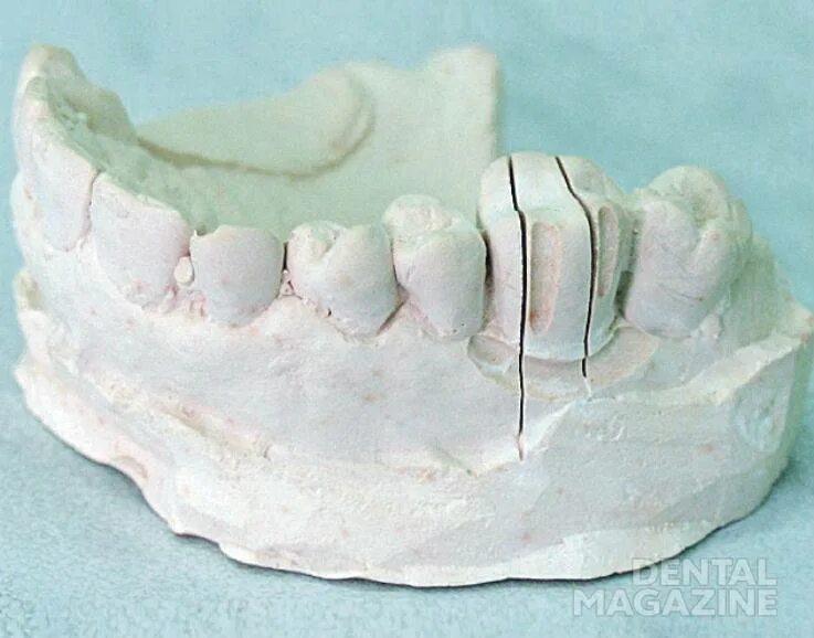 Гипс в стоматологии. Зубные слепки. Гипс в стоматологии. Гипсовые формовочные материалы. Гипс в стоматологии ортопедической.