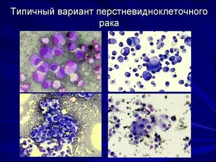 Цитология рак