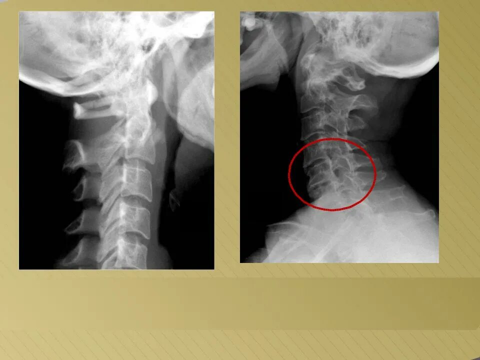 Кифоз шейного отдела рентген. Патологический кифоз шейного отдела рентген. Гиперлордоз шейного отдела позвоночника рентген. Шейный лордоз выпрямлен рентген.