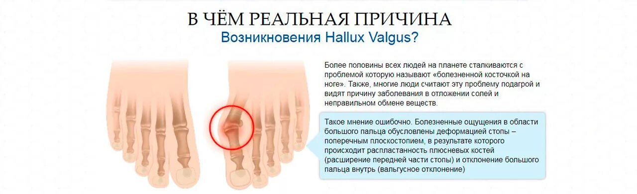Растущая кость на большом пальце. Причина халлюкс вальгус. Вальгусная деформация пальца стопы. Деформация большого пальца ноги.