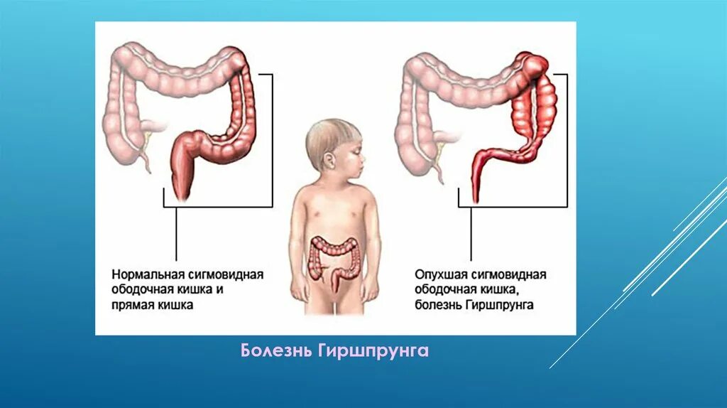 Ребенок сигма. Долихосигма у детей клинические рекомендации. Толстая кишка анатомия долихосигма. Болезнь Гиршпрунга сигмовидной кишки. Долихосигма ирригоскопия.