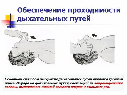 Методы восстановления проходимости дыхательных путей
