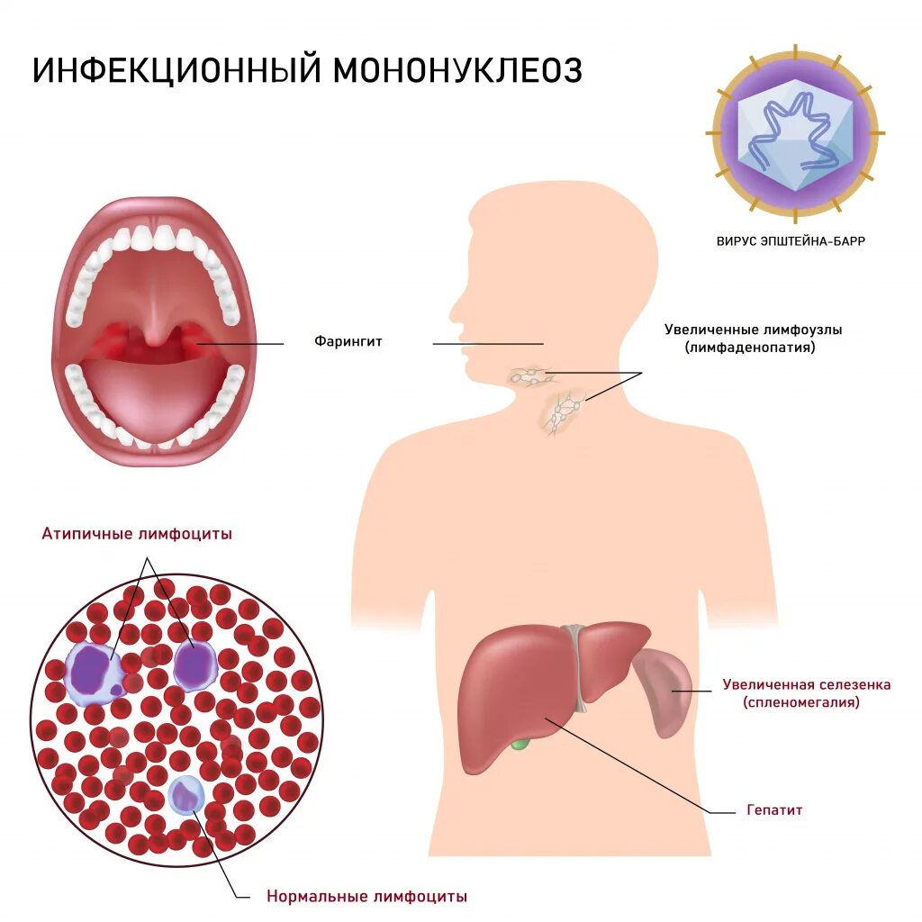 Моноуклеоз. Инфекционный мононуклеоз (вирус Эпштейна-Барр). Контагиозность мононуклеоза. Инфекционный мононуклеоз (инфекция вирусом Эпштейна — Барра). Вирус Эпштейн-Барр инфекция симптомы.