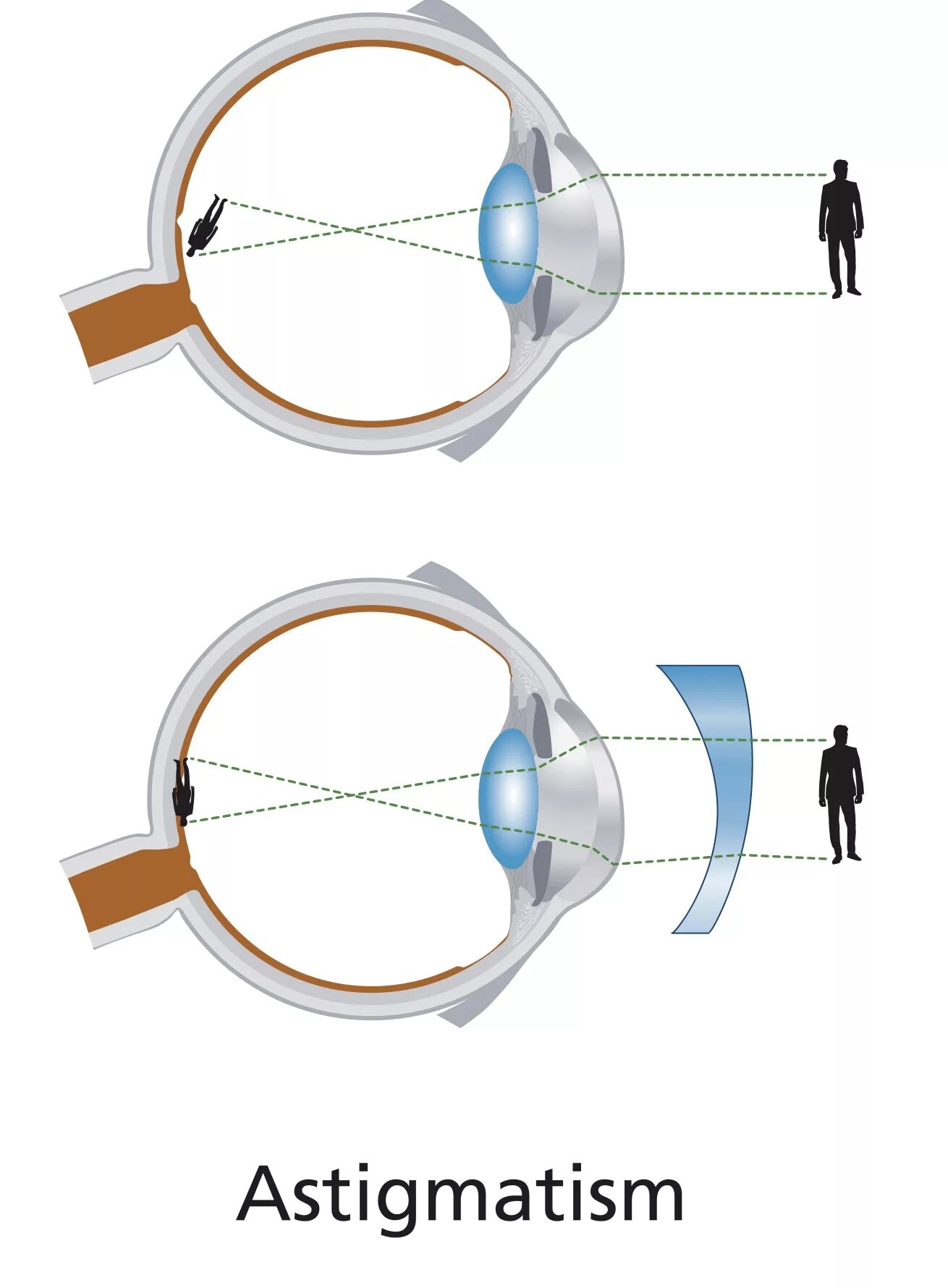 Строение глаза астигматизм. Цилиндрический астигматизм. Астигматизм 170. Астигматизм -1.75. Линзы для зрения дальнозоркость