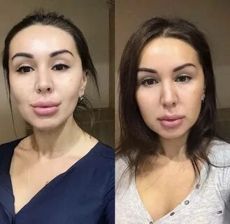 Операция убрать щеки