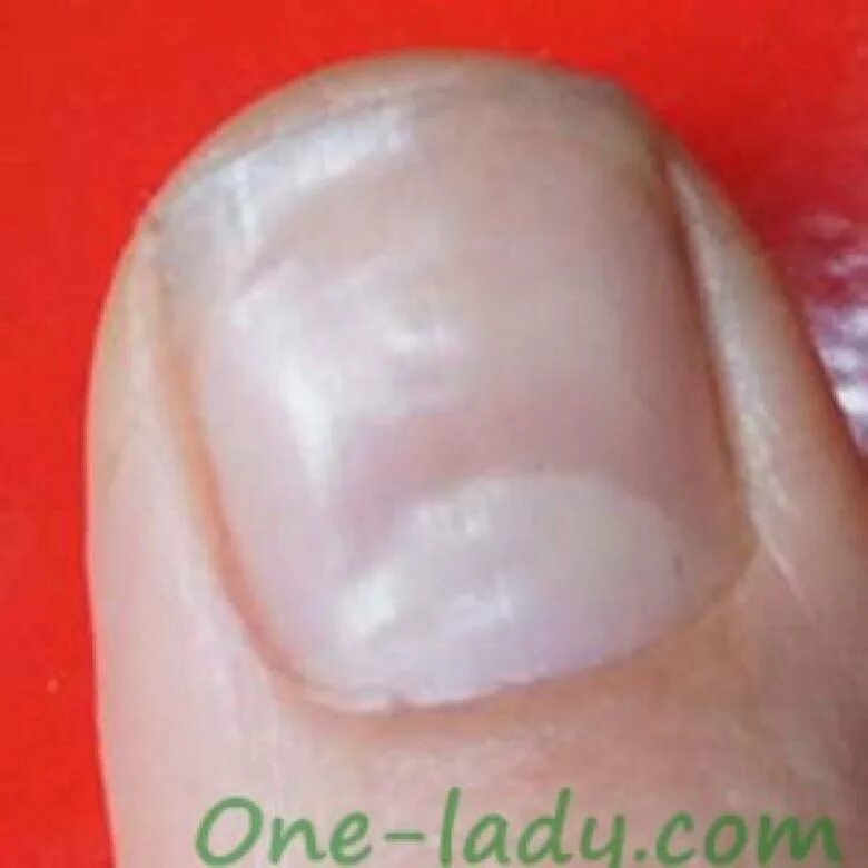 Кривой ноготь на большом пальце руки. Ониходистрофия - онихолизис. Неровности на ногтевой пластине. Кривой ноготь на большом пальце руки. Ямки на ногтях большого пальца руки.