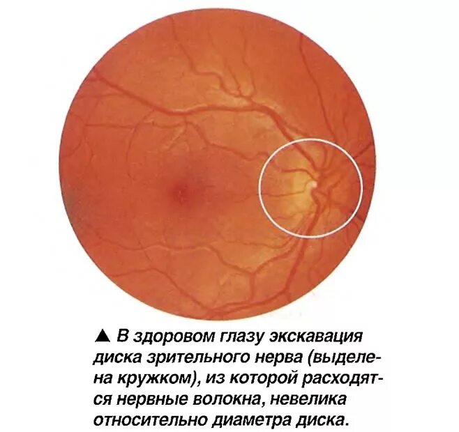 Норма зрительного нерва. Экскавация глазного дна. Миопический конус глазное дно. Глаукомная экскавация ДЗН. Экскавация диска при глаукоме.