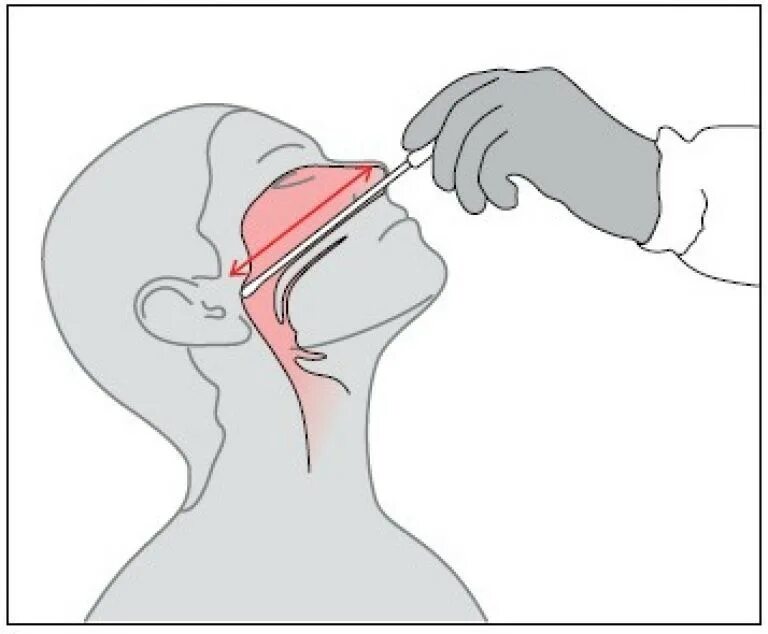 Техника взятия мазка на ковид из зева и носа алгоритм. Взятие мазка из зева и носа на ПЦР. Техника забора мазка на ковид 19. Алгоритм взятие мазка из зева и носа на ковид 19.