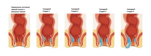 Tasma va anusning fotosuratlari
