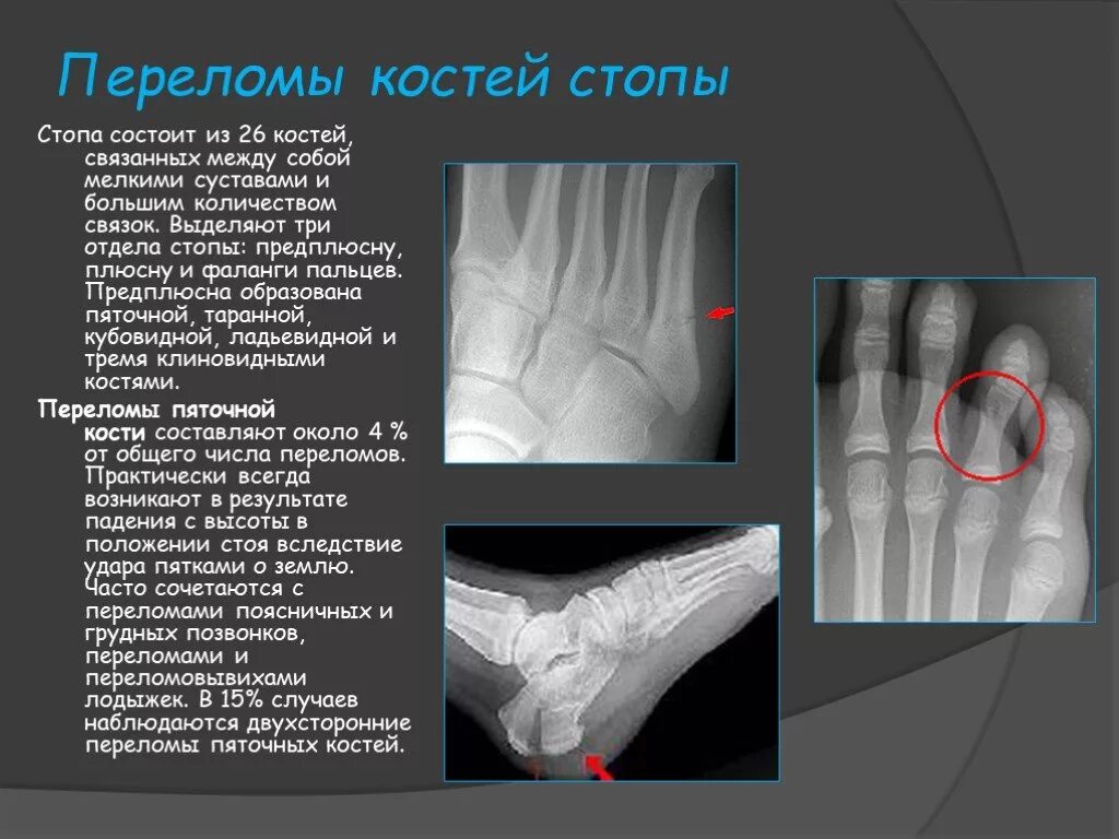 Симптомы перелома или трещины. Плюсневая кость перелом 1 кости. Перелом 2 плюсневой кости гипс. Перелом плюсневых костей рентген. Перелом левой плюсневой кости.