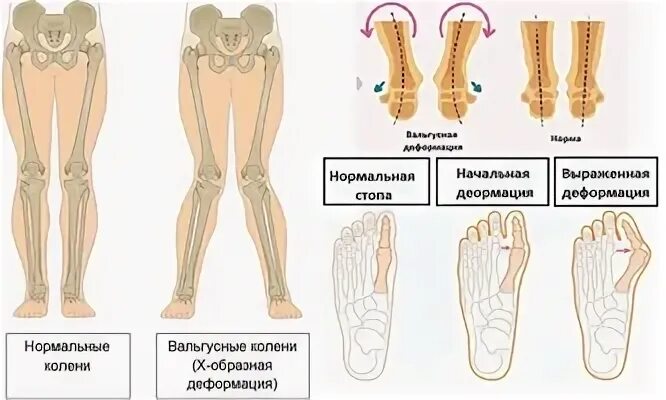 Вальгусная стопа и варусная стопа. Hallux valgus 1 плюснефалангового сустава. Вальгусное отклонение. Варусная вальгусная стопа у ребенка. Варусная и вальгусная деформация стоп.