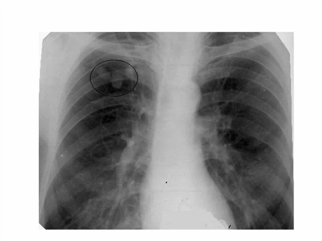 Очаговый бронхит. Туберкулема легкого рентген. Туберкулема фтизиатрия. Туберкулема легких рентгенограмма. Прогрессирующая туберкулема на рентгене.