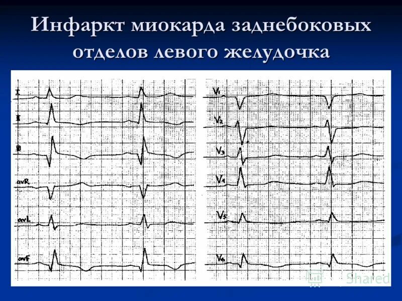 Изменение боковой стенки левого желудочка. ЭКГ при боковом инфаркте миокарда. Острый Нижний инфаркт миокарда левого желудочка. Заднебоковой инфаркт на ЭКГ. Нижний q инфаркт миокарда ЭКГ.