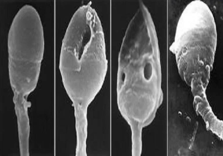 Спермотоксикоз у мужчин. Сперматозоид под микроскопом. Мутировавшие сперматозоиды. Здоровые сперматозоиды. Патология сперматозоидов.