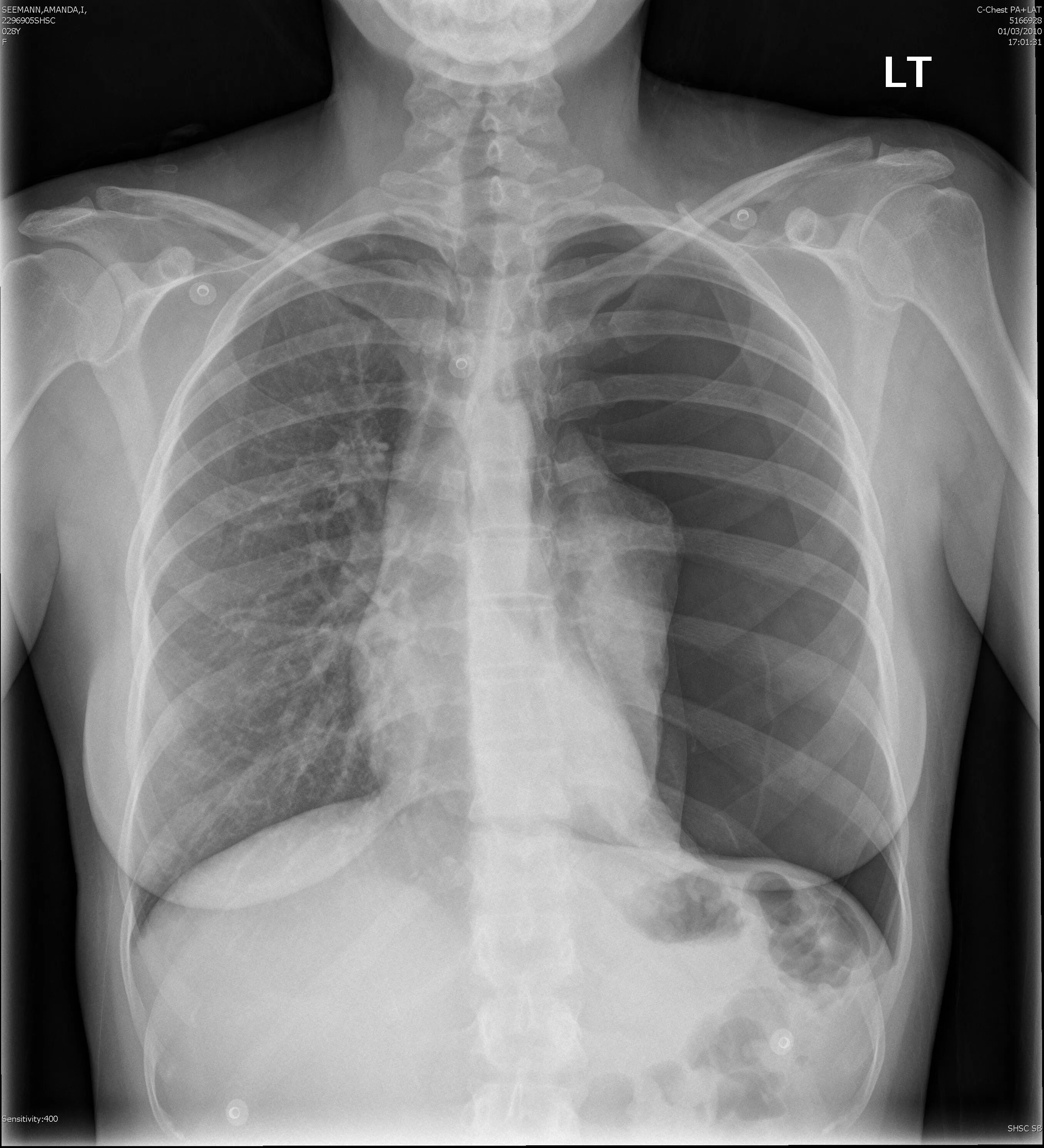 Пневмоторакс грудной клетки. Анатомия органов грудной клетки. Травма ОГК пневмоторакс.
