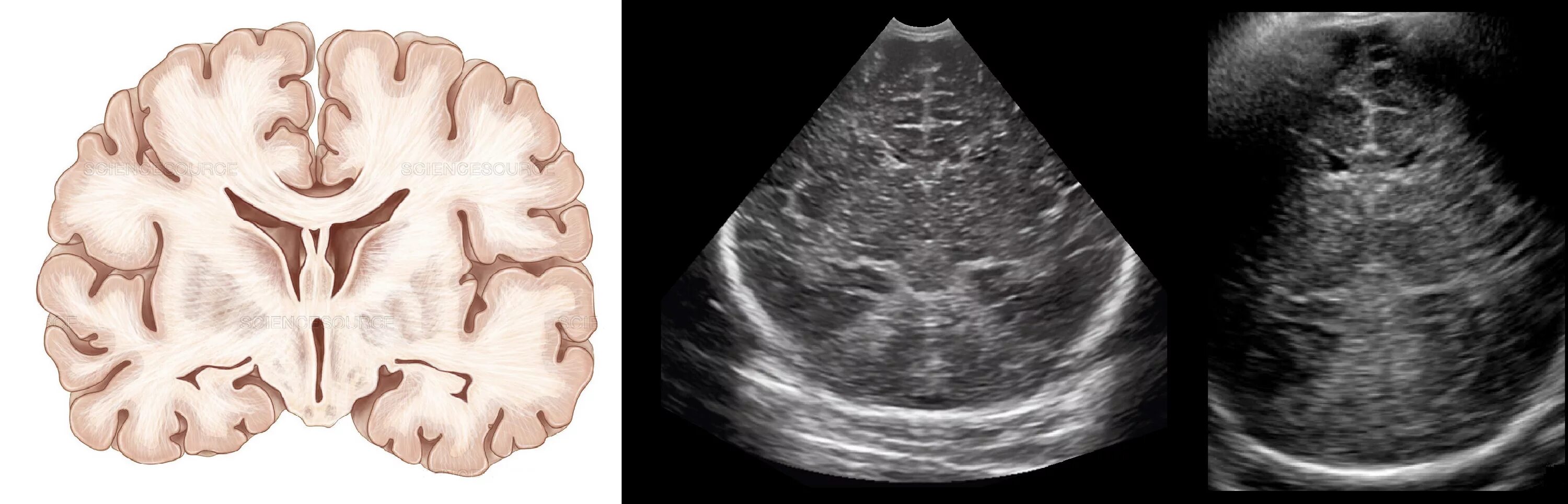 Нсг мозга. Нейросонография головного мозга грудничка норма. НСГ УЗИ головного мозга. УЗИ головного мозга нейросонография.