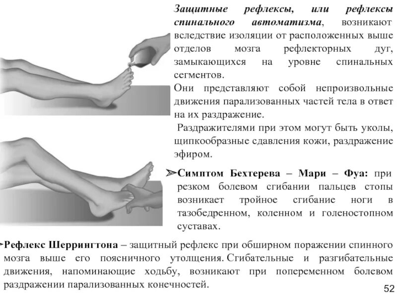 Симптом Бехтерева Мари фуа. Защитный рефлекс Бехтерева Мари фуа. Патологические пирамидные рефлексы, защитные спинальные рефлексы. Защитный (укоротительный) рефлекс Бехтерева-Мари-фуа.