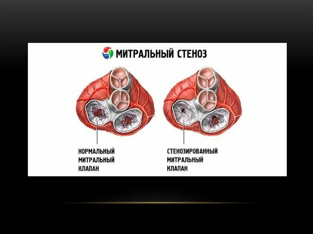 Относительный митральный стеноз. Нарушение гемодинамики при стенозе митрального клапана. Митральный стеноз пуговичная петля. Относительный митральный стеноз. Относительный митральный стеноз.