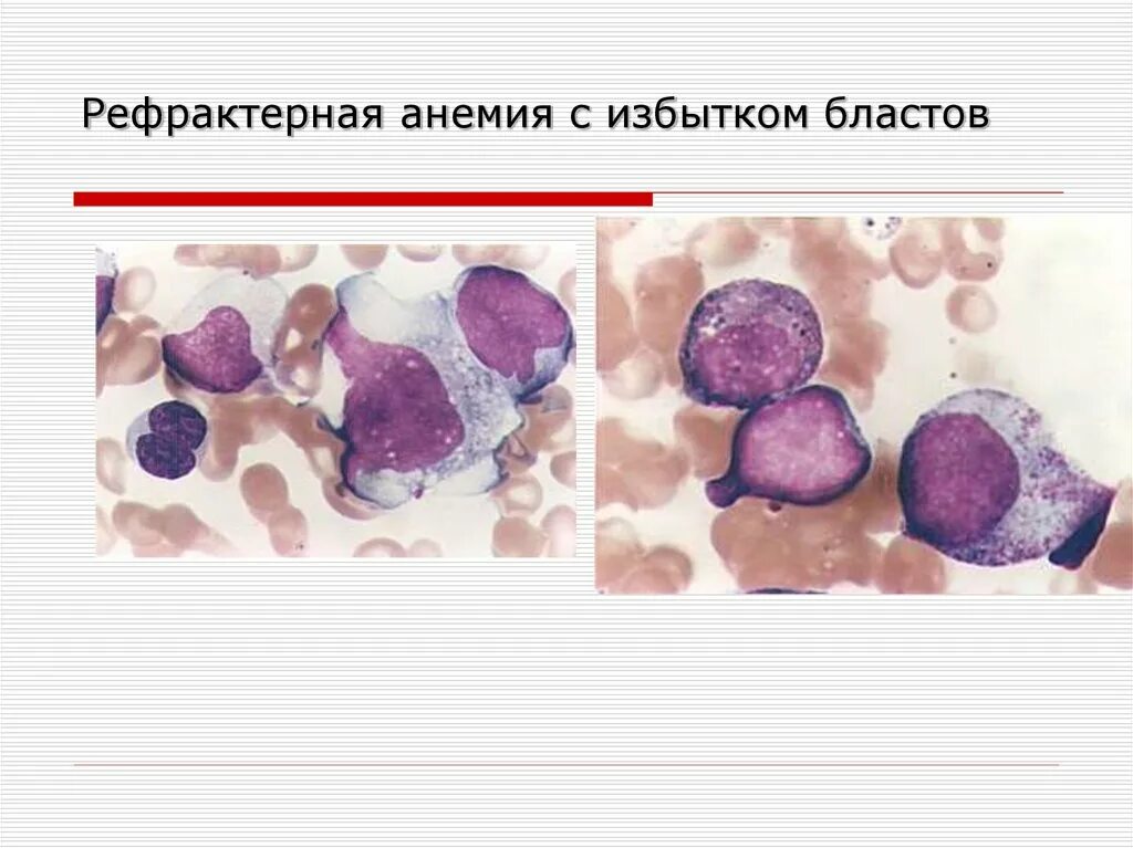 Рефрактерная анемия с кольцевыми сидеробластами. Миелодиспластический синдром. Миелодиспластический синдром (мдс). Миелодиспластический синдром рефрактерная анемия. Рефрактерная цитопения с мультилинейной дисплазией.