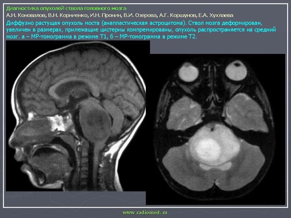 Объемное образование головного мозга код. Глиома продолговатого мозга мрт. Глиальная опухоль головного мозга кт. Глиома ствола головного. Диффузная глиома ствола головного.