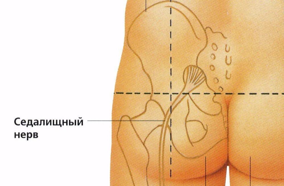 Внутримышечная инъекция ягодичная мышца. Куда ставить укол в ягодицу. Методика вентро-ягодичной инъекции. Осложнения вм инъекции. Инъекция попали в нерв.