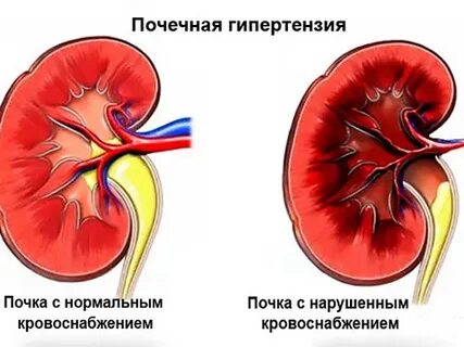 Почки и давление