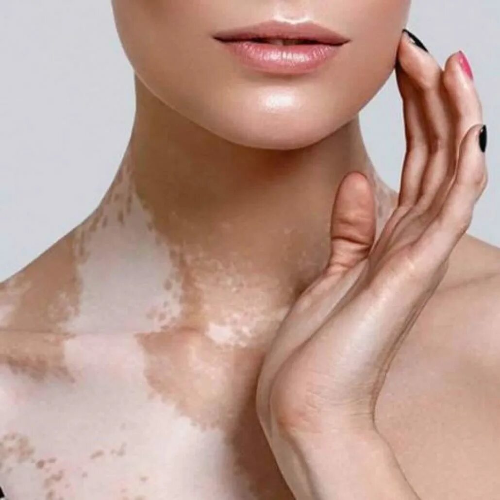 как называется болезнь белой кожи. как называется болезнь белой кожи. как называется болезнь белой кожи. акрофациальное витилиго. витилиго депигментация.