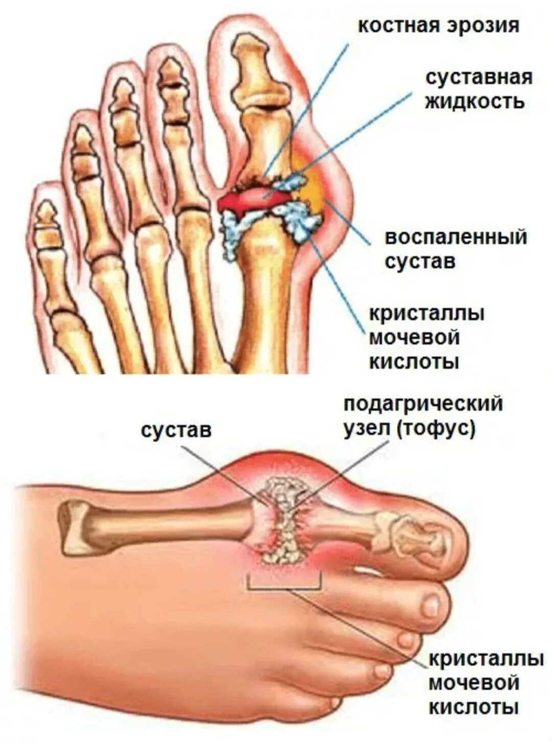 Суставы пальцев сильно. Подагра соли в суставе. Подагрические узлы тофусы. Сустав большого пальца ноги.