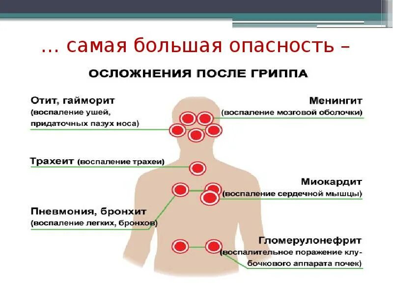 Осложнения гриппа. Осложнения после гриппа у детей. Большая опасность. Осложнения после гриппа симптомы. Какие осложнения после ковида