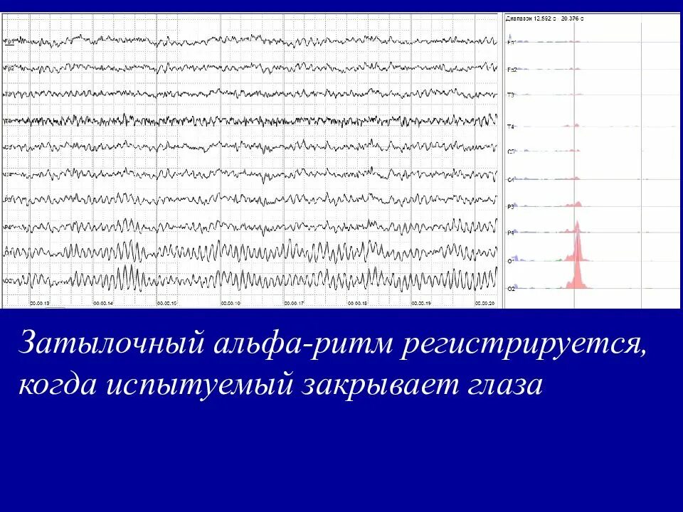 Норма бета ритма на ЭЭГ. Дезорганизованная Альфа-активность на ЭЭГ. ЭЭГ головного мозга ритм Альфа ритм норма. Норма Альфа ритма при ЭЭГ. Ээг глаза