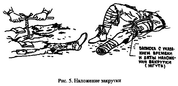 При отеке легких жгуты накладывают. Наложение жгута при отёке лёгких. Наложение жгута на шею при ранении сонной артерии. Наложение жгутов при отеке легких алгоритм.