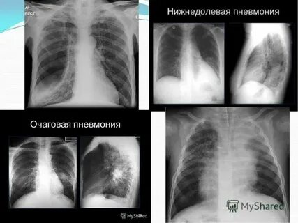 При пневмонии делают рентген