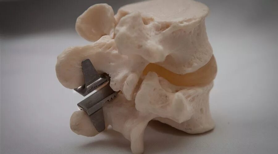 Операция замена дисков позвоночника. Межпозвоночный имплант l5 s1 Diam. Имплант Кофлекс грыжа. Титановый имплант COFLEX. Силиконовый имплант в позвоночнике грыжа.