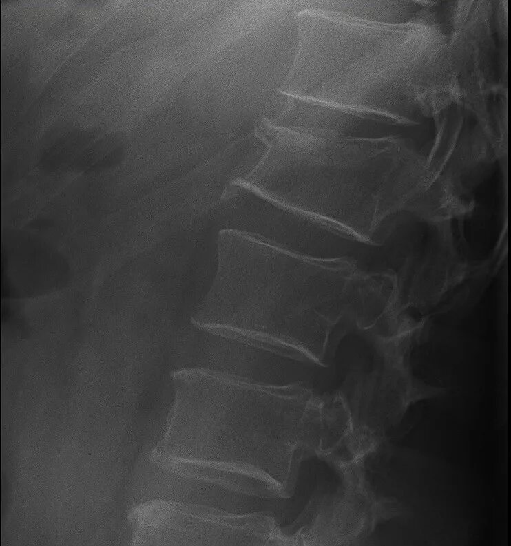 Компрессионный перелом позвонка рентген. Компрессионный перелом тела позвонка рентген. Компрессионный перелом позвоночника поясничного отдела рентген. Компрессионный перелом позвонка рентген остеопороз.