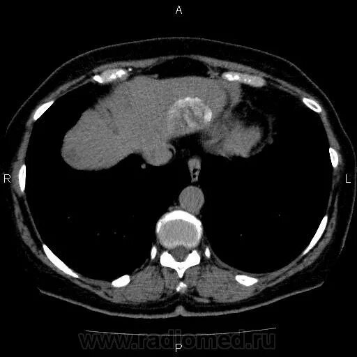 Гиподенсивное образование в печени на кт. Обызвествления в печени на кт. Обызвествленное образование печени кт. Множественные гиподенсивные образования в печени кт. Гиподенсивное образование в печени