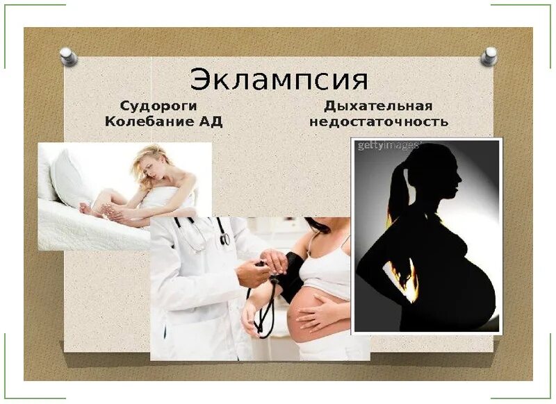 Судороги при беременности 2 триместр. Эклампсия у беременных. судороги беременных эклампсия. эклампсический судорожный припадок.