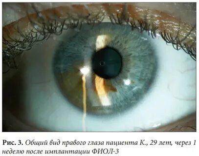 Факичной линзы отзывы