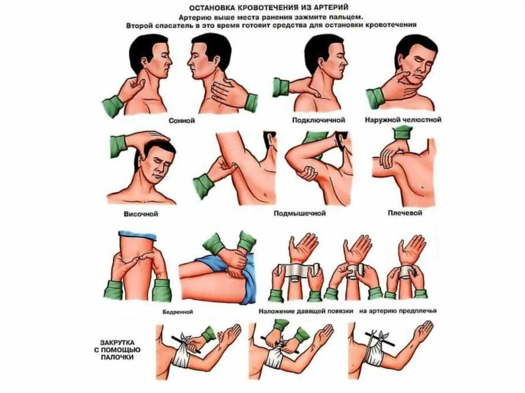 Схема остановки кровотечения. Остановка кровотечений прижатием сосуда пальцами. Остановка кровотечения прижатием артерий. Остановка кровотечения с рукой й.