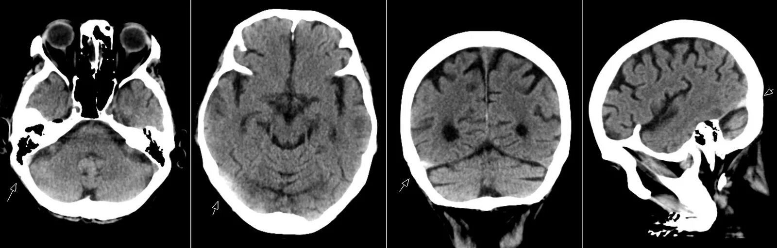 Тромбоз поперечного синуса кт. Тромбоз синусов головного мозга кт. Тромбоз венозного синуса на кт. Тромбоз кавернозного синуса мрт. Гипоплазия правых синусов