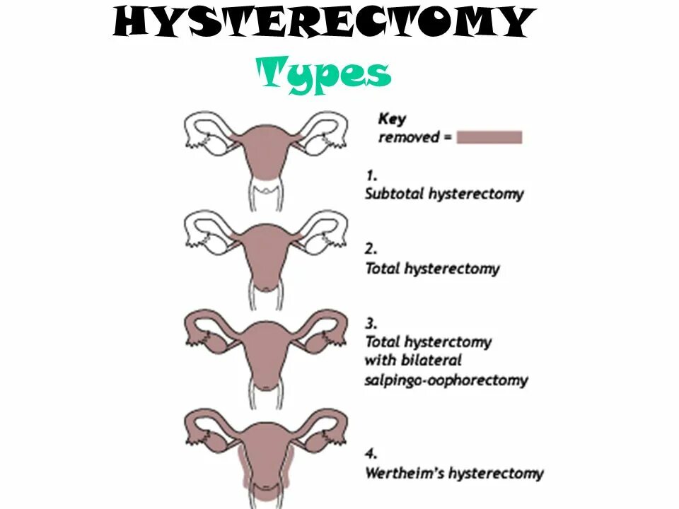 Экстирпация матки с придатками. Гистерэктомия классификация. Лапароскопия тотальная гистерэктомия. Лапаротомия экстирпация матки.