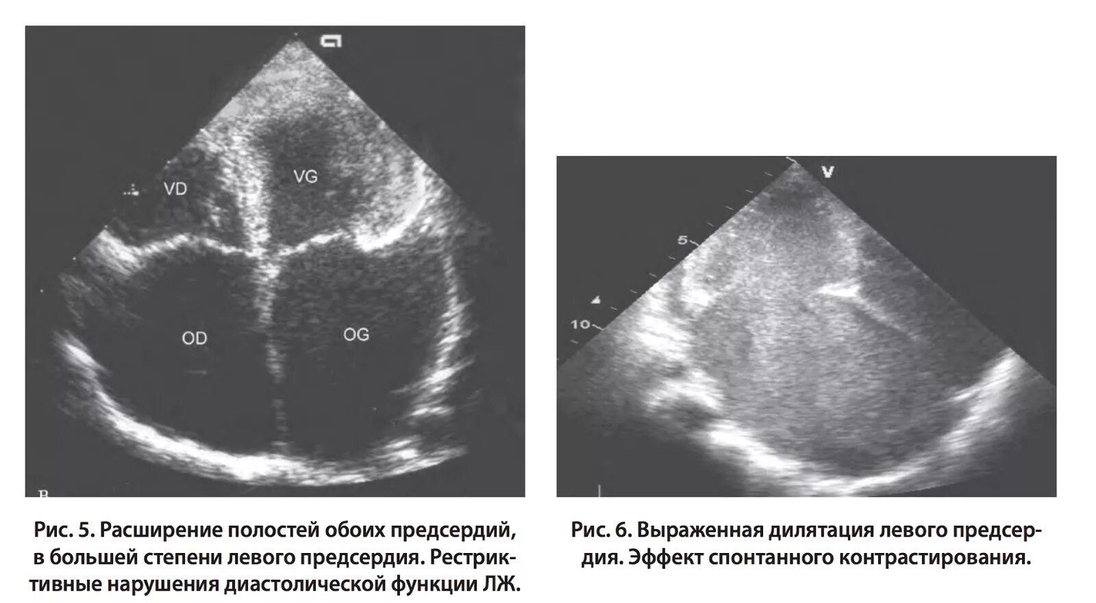 Эффект спонтанного контрастирования левого желудочка. Дилатация левого предсердия ЭХОКГ. УЗИ добавочная хорда левого желудочка. Расширение предсердий. Дилатация полостей предсердий