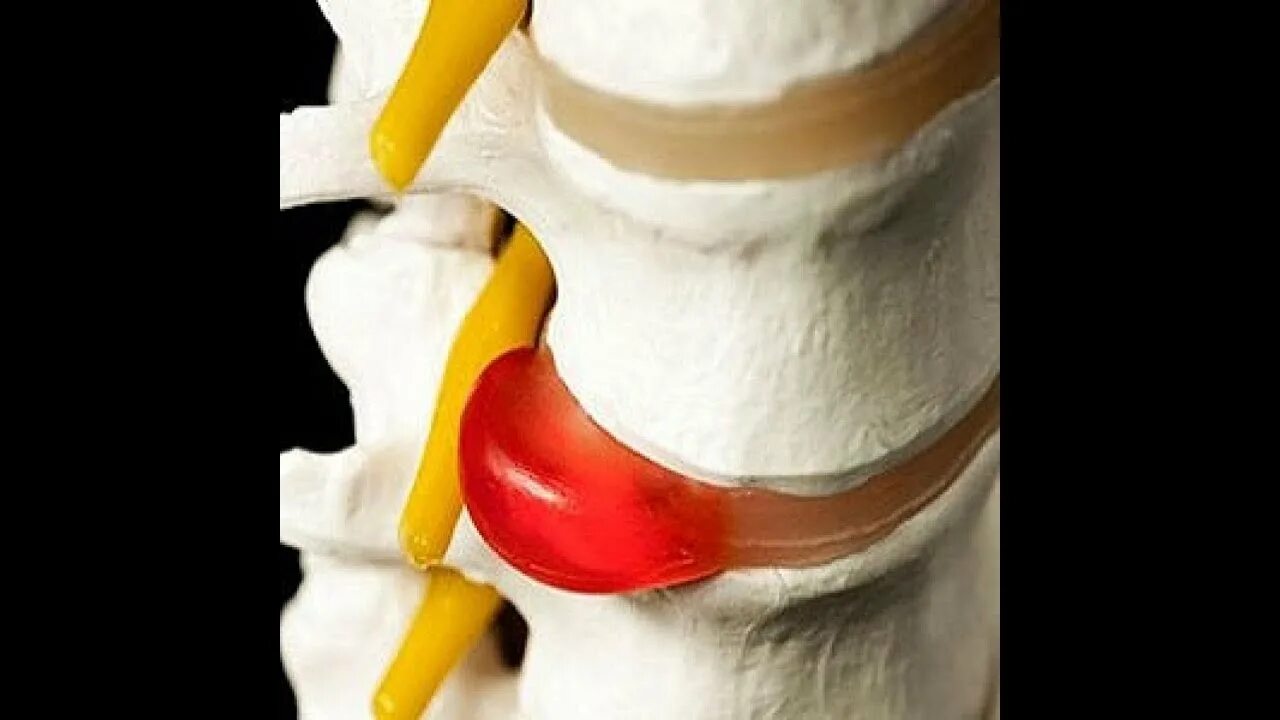 Межпозвонковая грыжа без операции. Позвоночная грыжа. Позвоночная грыжа операция. Операция на грыжу позвоночника поясничного отдела. Грыжа удаленная позвоночника поясничного отдела.