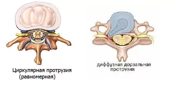 Диффузное выбухание межпозвоночного. Циркулярно дорсальная протрузия межпозвоночного диска. Диффузная дорзальная протрузия/грыжа. Диффузная протрузия межпозвонкового диска. Дорзальная протрузия диска позвоночника.