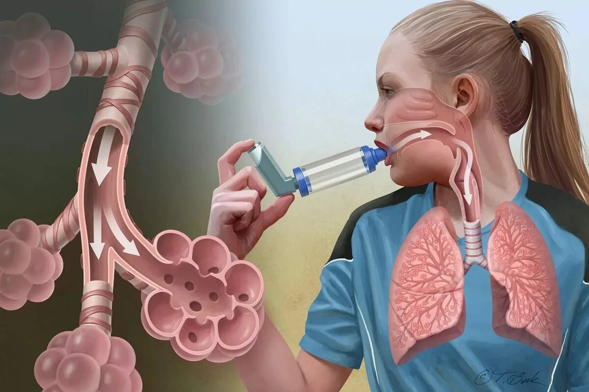 Bronchial asthma
