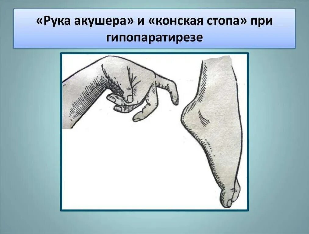 Рука акушера это симптом при. Симптом рука. Симптомы поражения срединноонерва. Синдром поражения срединного нерва. Симптом рука.