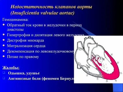 Недостаточность устья аорты