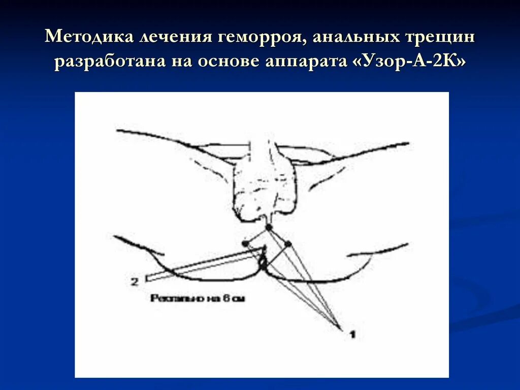 Геморроидальные трещины. Иссечение хронической трещины. Трещина на геморроидальном узле. Иссечение геморроидальной трещины.